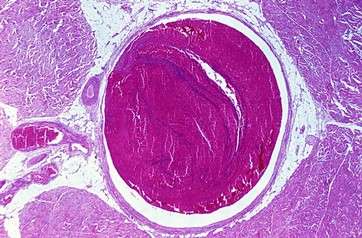 Venous thrombosis by .