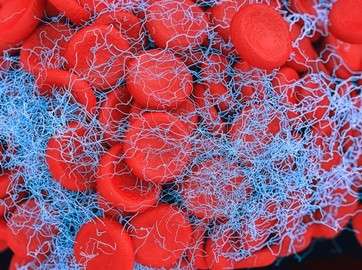 Blood clot. by .