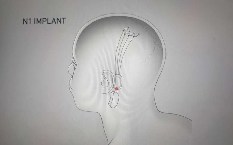 To help paralyzed people control devices and empower people with brain disorders enrich their lives, Elon Musk-led startup Neuralink has revealed tiny brain "threads" in a chip which is long lasting, usable at home and has the potential to replace cumbersome devices currently used as brain-machine interfaces. The company is seeking the US Food and Drug Administration (FDA) approval to start clinical trials on humans in 2020. by . 