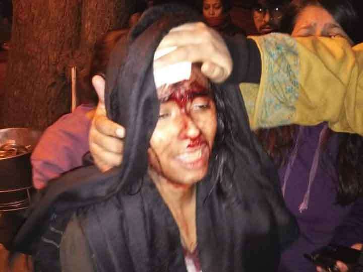 New Delhi: A girl student at JNU was hit over the eye with a rod after clashes erupted between groups of students at JNU campus in New Delhi on Jan 5, 2020. (Photo: IANS) by .